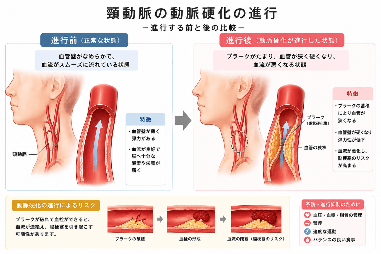 頸動脈の動脈硬化が進行する前と後の比較図